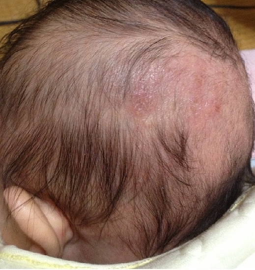 頭皮 湿疹 赤ちゃん