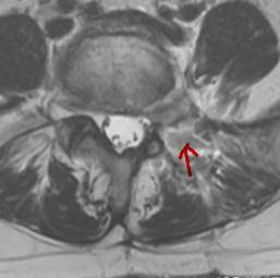 術後椎間孔狭窄　　術後MRI 横断