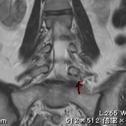 術後椎間孔狭窄　　術後MRI 冠状断
