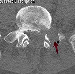 術後椎間孔狭窄　　術後CT　横断