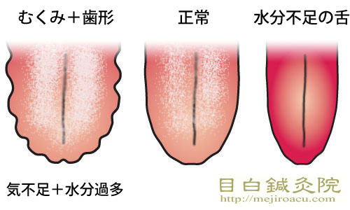 歯形舌・ギザギザ舌・歯痕舌（しこんぜつ）20140625